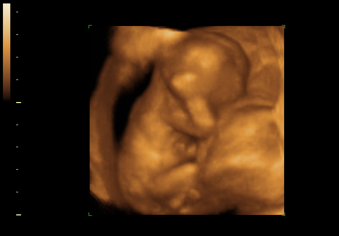 3D ultrasound image at 14 weeks